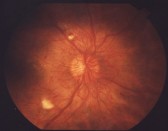 retinopathy.jpg
