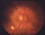 словарь:retinopathy.jpg